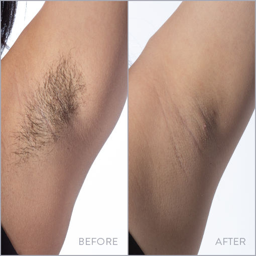 Underarm Laser Hair Removal